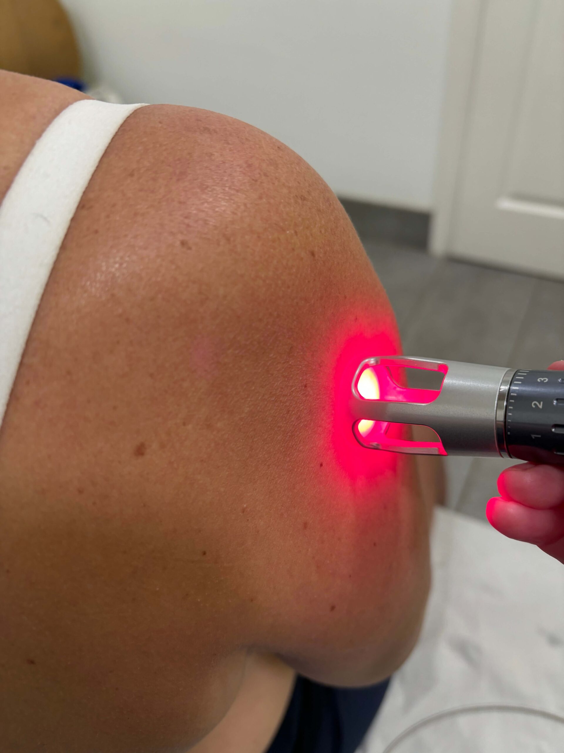 shockwave a women's arm getting shockwave treatment