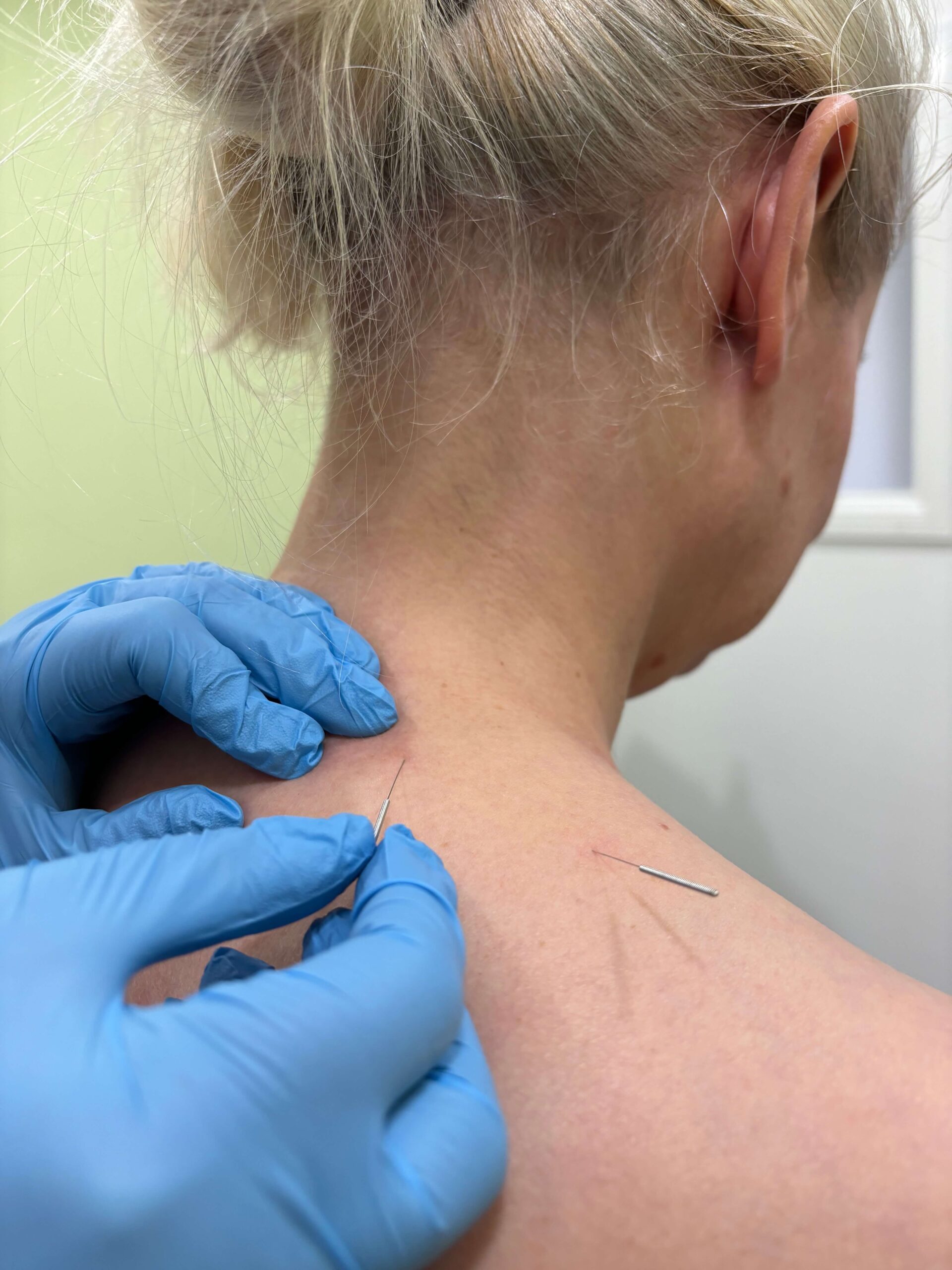 acupuncture a ladies back with acupuncture needles in